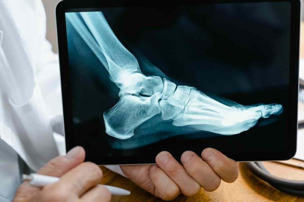 person holding a tablet with an X-ray of the foot showing the MTP joint